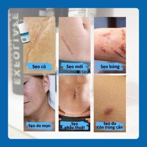 Gel Trị Sẹo Lồi Scarguard Repair Liquid 15ml (Scarguard MD)